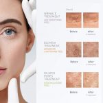 probione-peel-skeyndor-ολοκληρωμένο-πρόγραμμα-επαγγελματικού-χημικού-peeling-περιποιηση-προσωπου